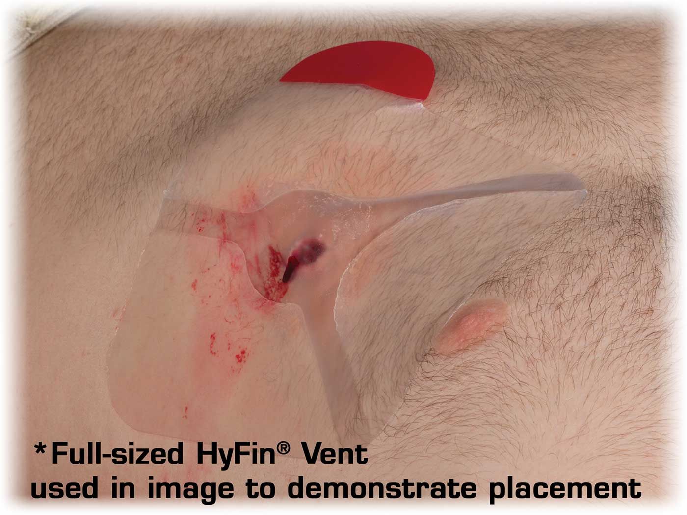 Hyfin Vent Compact Chest Seal Twin Pack for bleeding management, showing sealed plastic packaging with two chest seals.